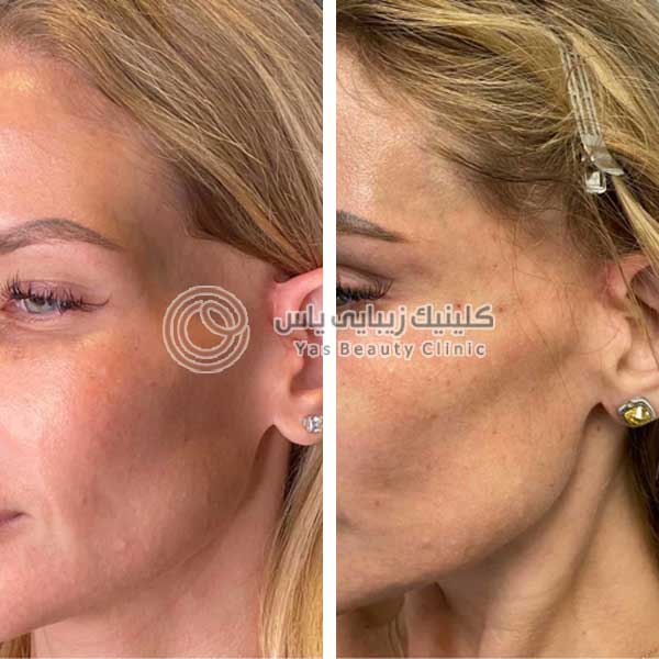فیلر شقیقه در بندرعباس