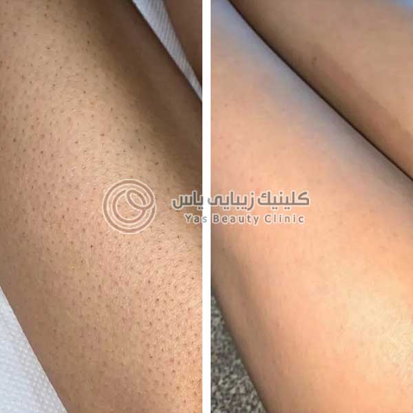 لیزر موهای زائد الکس در بندرعباس
