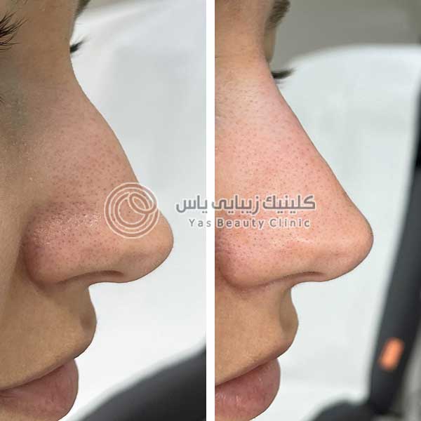 بوتاکس بینی در بندرعباس